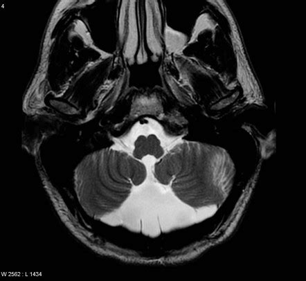 mega cisterna magna radiology|sudden death in mega cisterna magna.